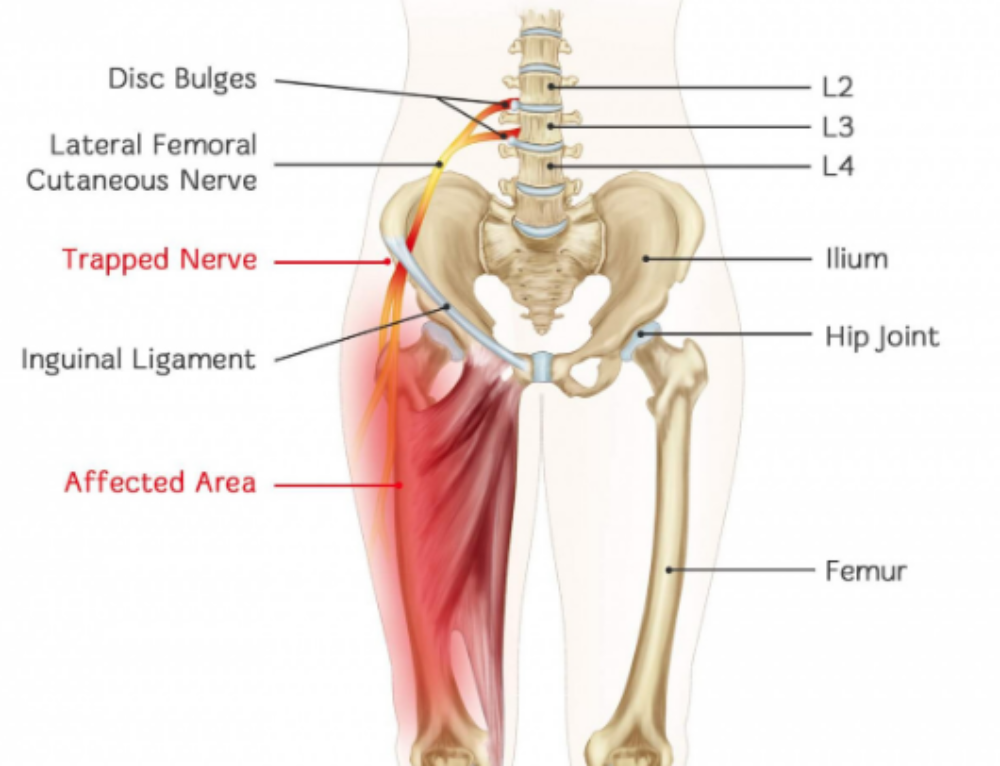 Онемение левого бедра с внешней